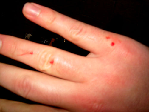 [ Hand damage ]